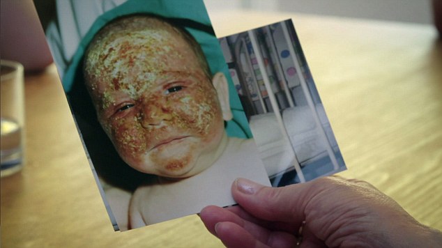 Уникална история! Този човек е алергичен към слънцето, но вече спокойно излиза навън, само слага... (СНИМКИ/ВИДЕО)